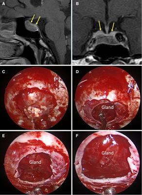 Clinical application of the “sellar barrier’s concept” for predicting intraoperative CSF leak in endoscopic endonasal surgery for pituitary adenomas with a machine learning analysis